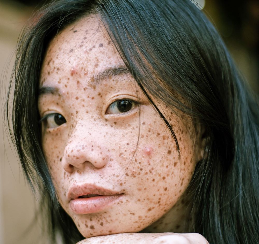 CBD Vs Acne